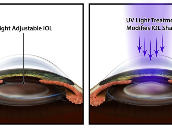 All about Light Adjustable Intraocular Lenses