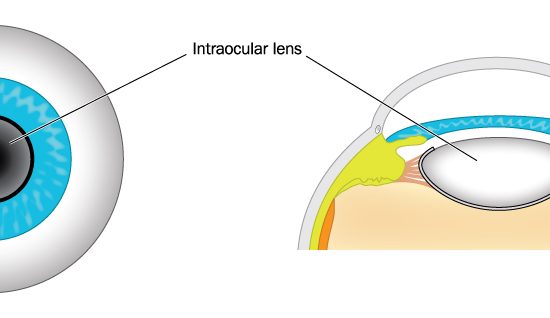 The benefits of intraocular lenses
